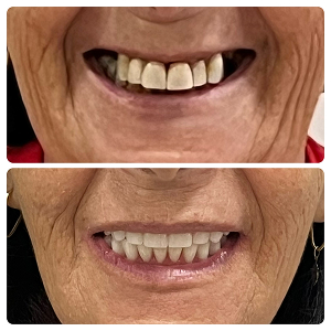 antes-depois-implantes1