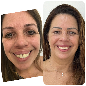 antes-depois-implantes2