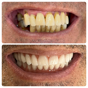 antes-depois-implantes3