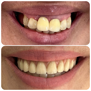 antes-depois-implantes4